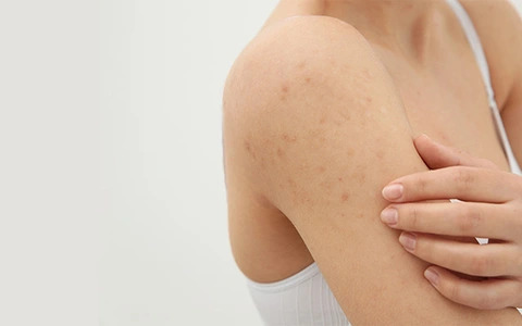 Nguyên nhân viêm nang lông ở các vùng da trên cơ thể