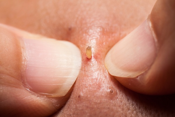Mách nước cách trị mụn đầu đen hiệu quả, đơn giản